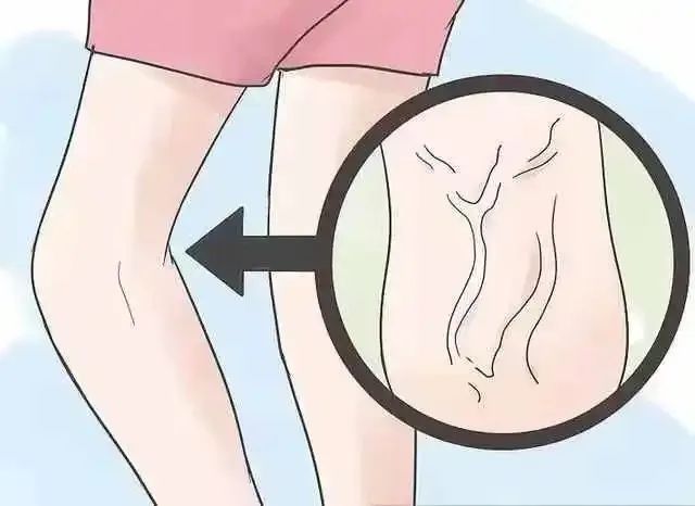 科普丨特朗普被确诊的静脉疾病是什么