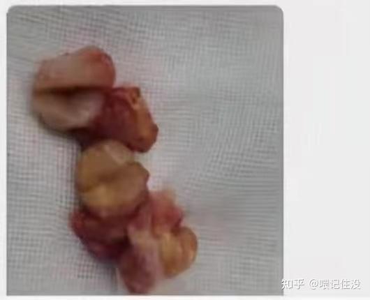 阿里健康拿下贝捷迈®全国首发 系中国首个腱鞘巨细胞瘤（TGCT）口服新药