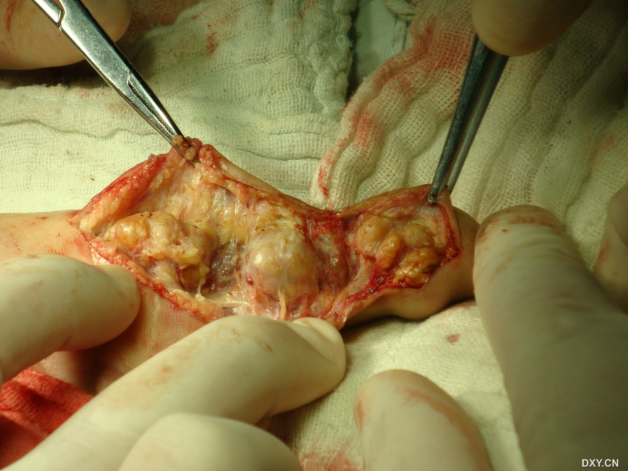 阿里健康拿下贝捷迈®全国首发 系中国首个腱鞘巨细胞瘤（TGCT）口服新药